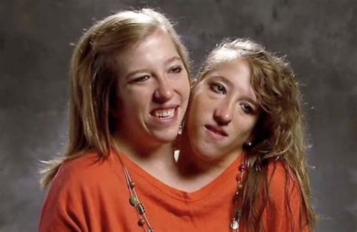 Heartfelt Reflections on Abby and Brittany Hensel: The Sad News