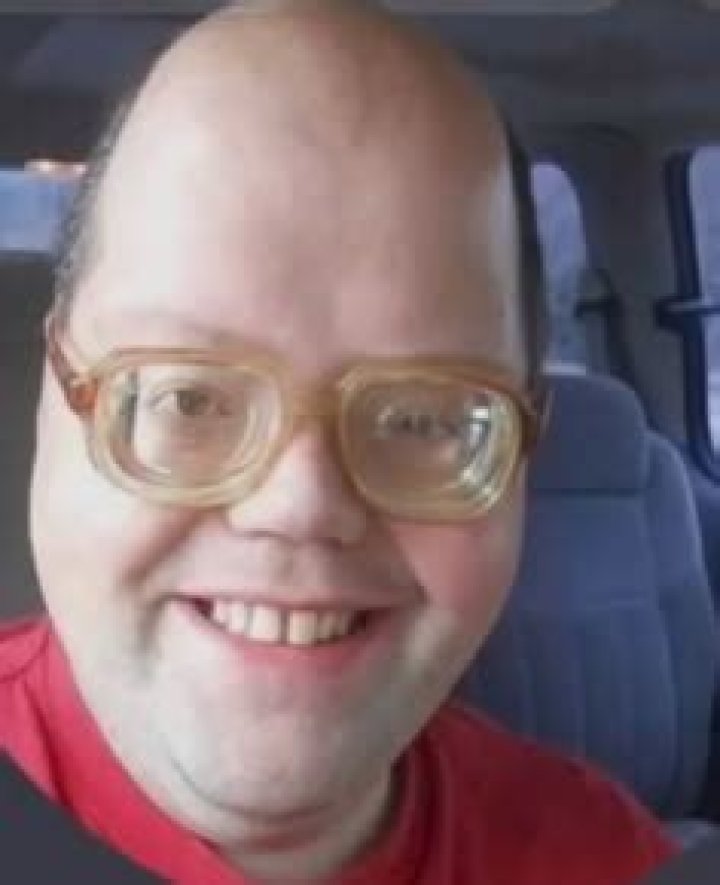 Understanding the Big Forehead: Myths, Facts, and Beauty Trends