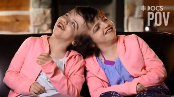 Journey of the Unbreakable Bond: Conjoined Twins Tatiana and Krista 2024
