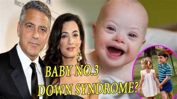 George Clooney's Twins and Down Syndrome: A Comprehensive Insight