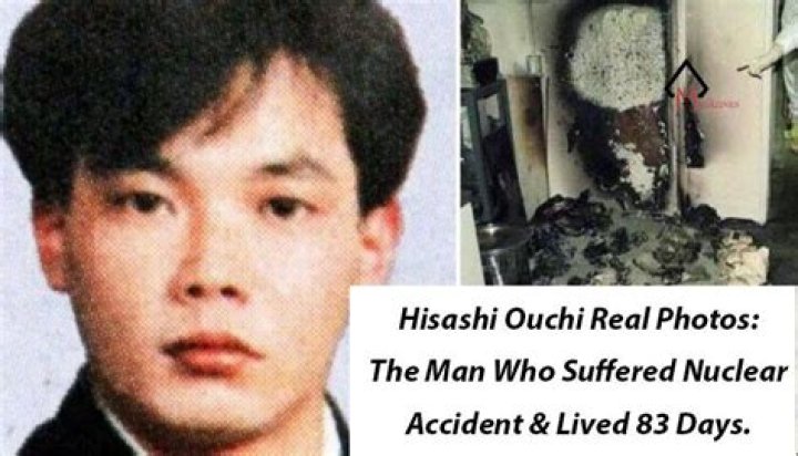Hisashi Ouchi: The Real Photo and Story Behind the Tragedy
