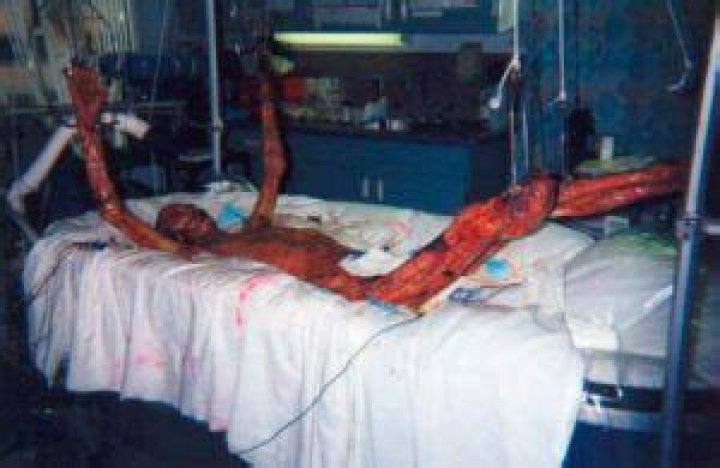 Hisashi Ouchi: The Untold Story of a Tragic Nuclear Accident Survivor