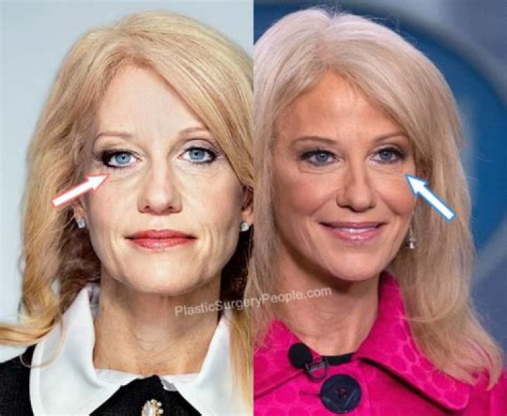 Kellyanne Conway's New Face: A Remarkable Transformation