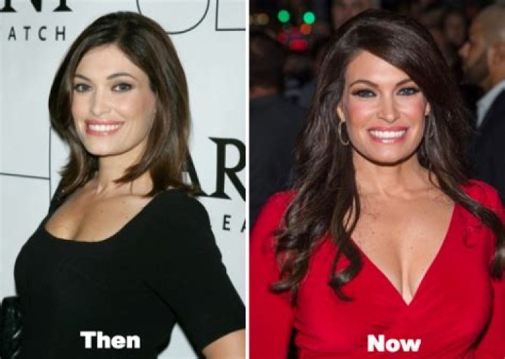 Revealing the Transformation: A Look at Kimberly Guilfoyle's Plastic Surgery Photos