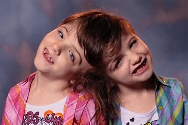 Krista and Tatiana Hogan: The Remarkable Journey of Conjoined Twins