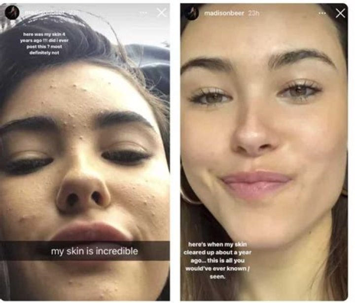 Madison Beer Without Makeup: Embracing Natural Beauty
