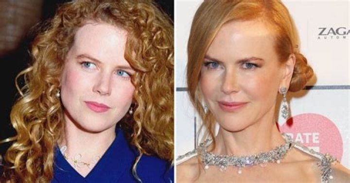 Nicole Kidman Plastic Surgery: The Undoing