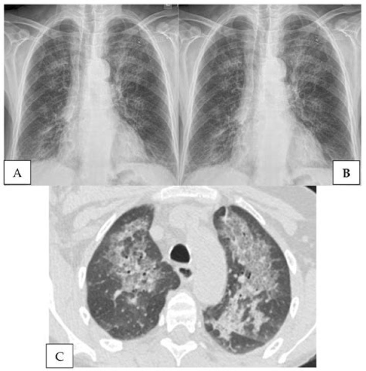 Pneumonia P. Diddy: Understanding the Health Condition and Its Implications