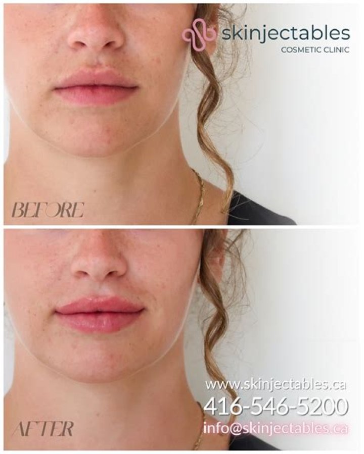 Best Skin Injectables for a Younger You