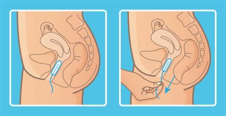 Where Does a Tampon Go? A Comprehensive Guide for Beginners
